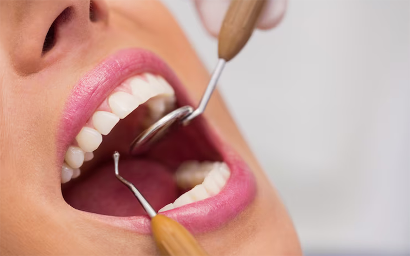 برای لمینت دندان باید عصب کشی کرد