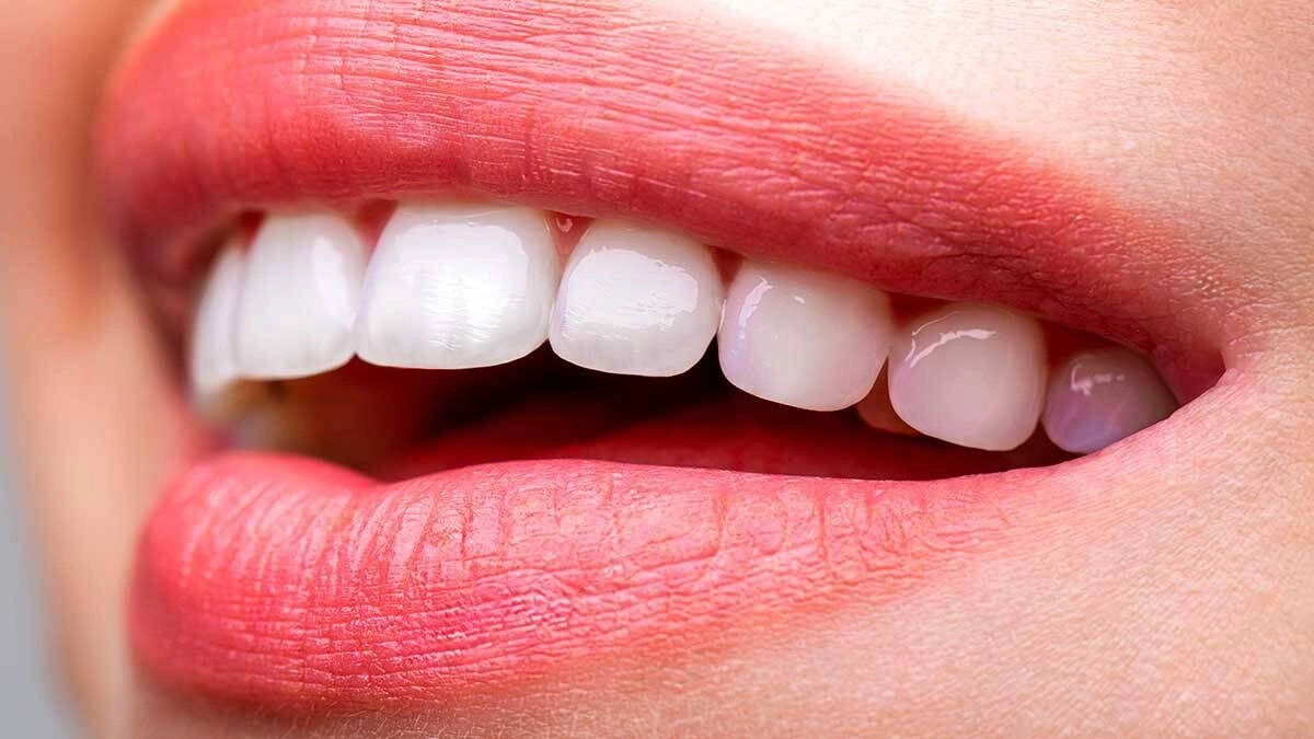 آیا لمینت دندان دائمی است؟