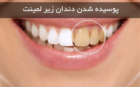 ‎⁨⁨آیا لمینت باعث پوسیدگی دندان میشود⁩⁩