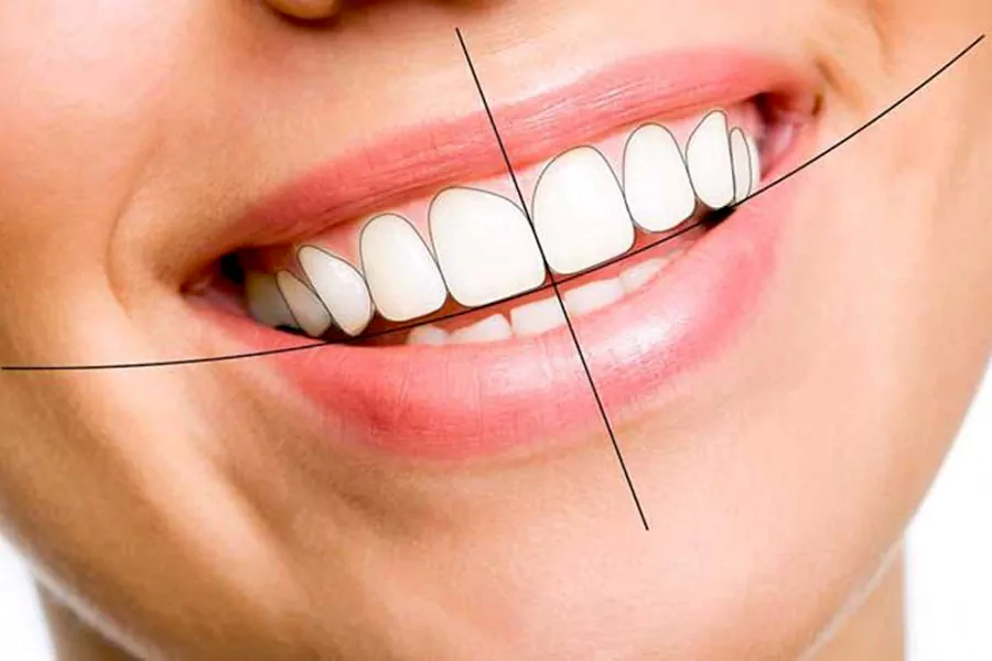 لمینت دندان برای چه کسانی مناسب است