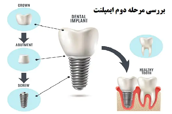 مرحله دوم ایمپلنت چگونه است