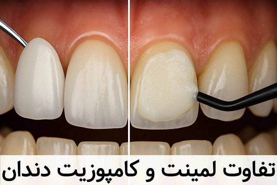 لمینت دندان چه فرقی با کامپوزیت دارد