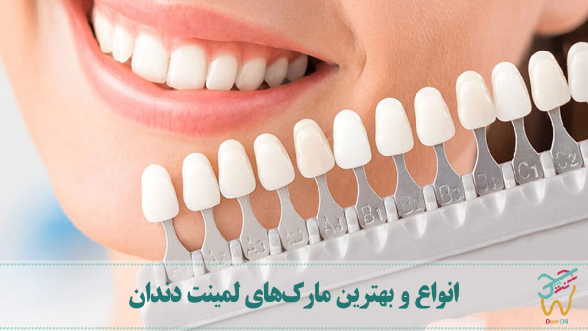 انواع برندهای لمینت دندان