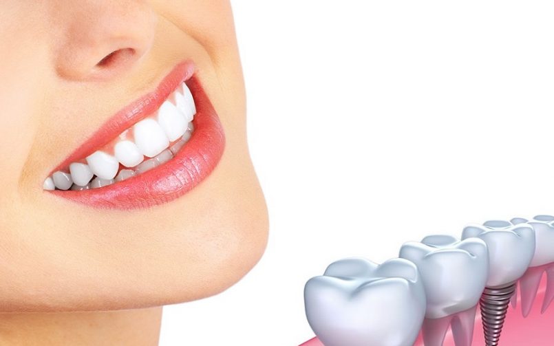 برای ایمپلنت چه آزمایشاتی لازم است