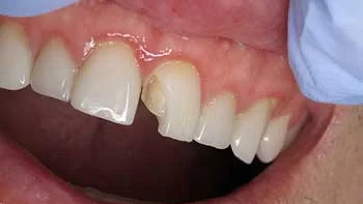 ایا لمینت دندان می افتد