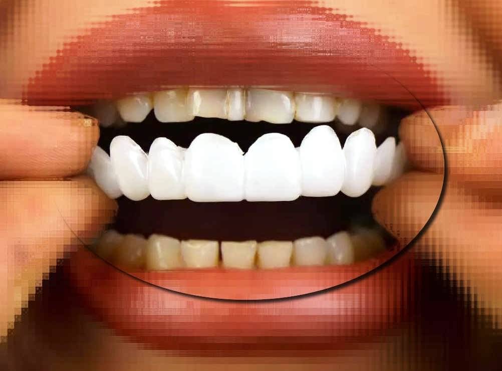 لمینت متحرک دندان را چگونه استفاده کنیم